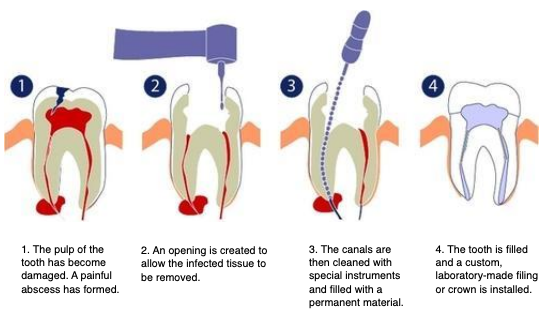 Root canal treatment diagram