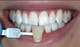 After whitening treatment